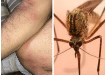 Qytetari publikon fotografi, thotë se u pickua 15 herë nga mushkonjat brenda 15 minutave