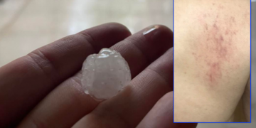 Një person në Prishtinë pëson lëndime nga breshri